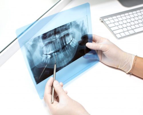 dentist examines x ray photo of teeths